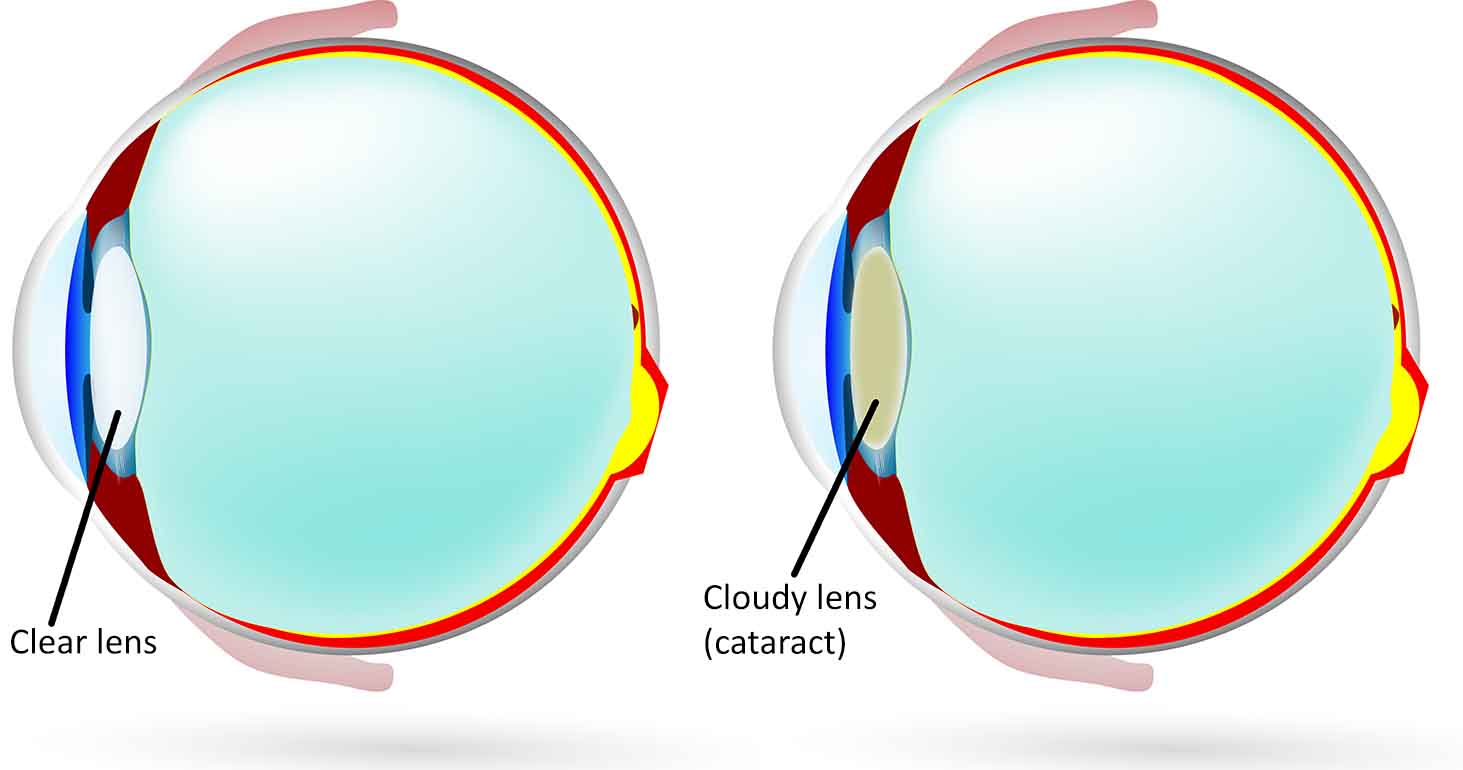 白内障手术后再次复发怎么办,做完白内障手术再发白内障怎么办
