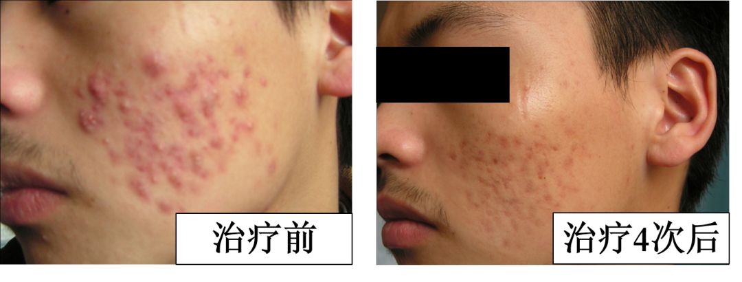 中医火针疗法教学视频,火针操作手法