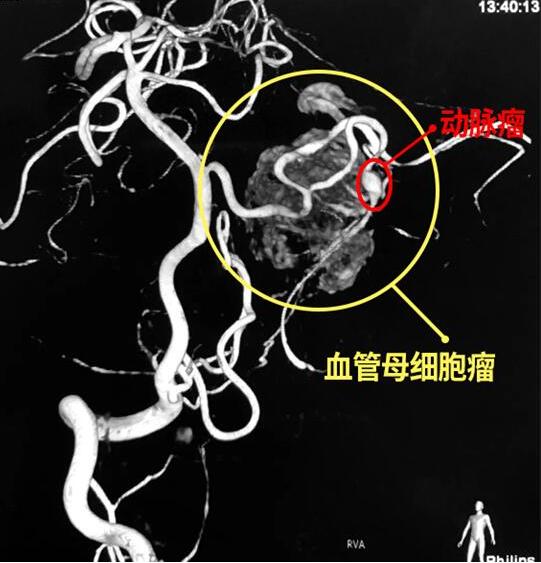 脑肿瘤恶心呕吐怎样护理,长期头晕发现脑肿瘤