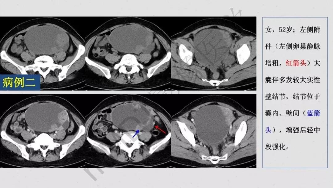 卵巢原发肿瘤的分析思路