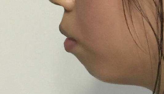 凸嘴皮肤不好怎么逆袭,凸嘴如何逆袭完美侧脸