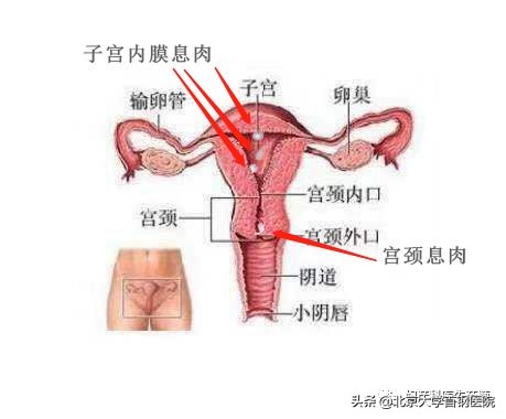 子宫长息肉了手术需要住院吗,子宫长息肉了必须马上做吗