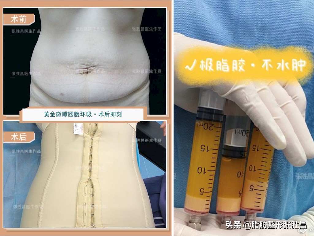 产后胖宝妈,产后肚子脂肪厚怎么减肥腹肌分离