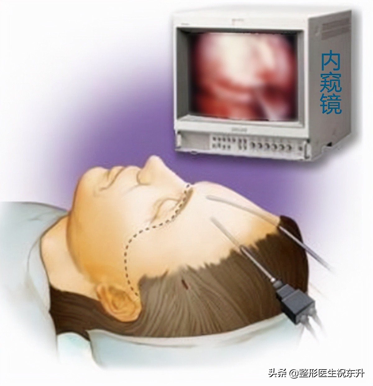 做拉皮手术的亲身经历告诉你,揭秘拉皮手术的4个真相