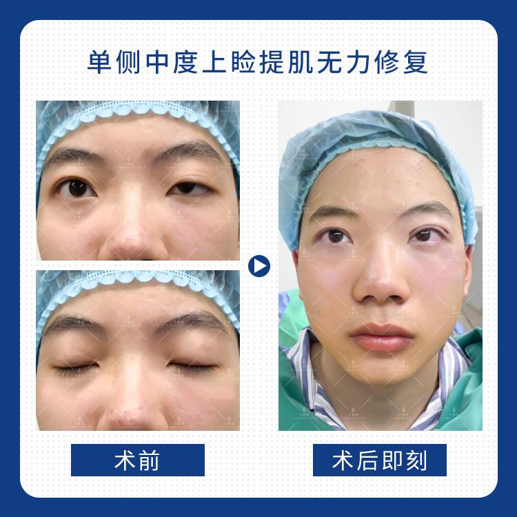 于景浩修复双眼皮图片,于景浩做双眼皮修复怎样