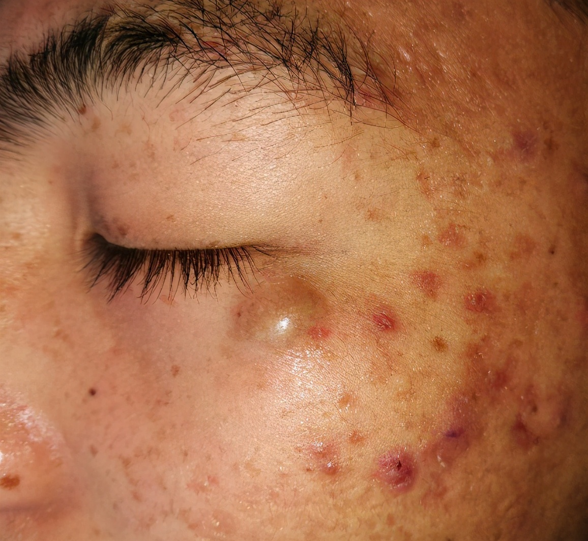 枕部表皮囊肿是怎么回事,表皮囊肿是如何形成的呢