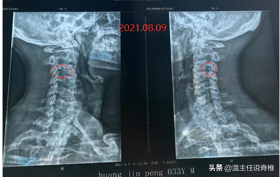 外科医生做脊椎手术,脊椎病保守治疗