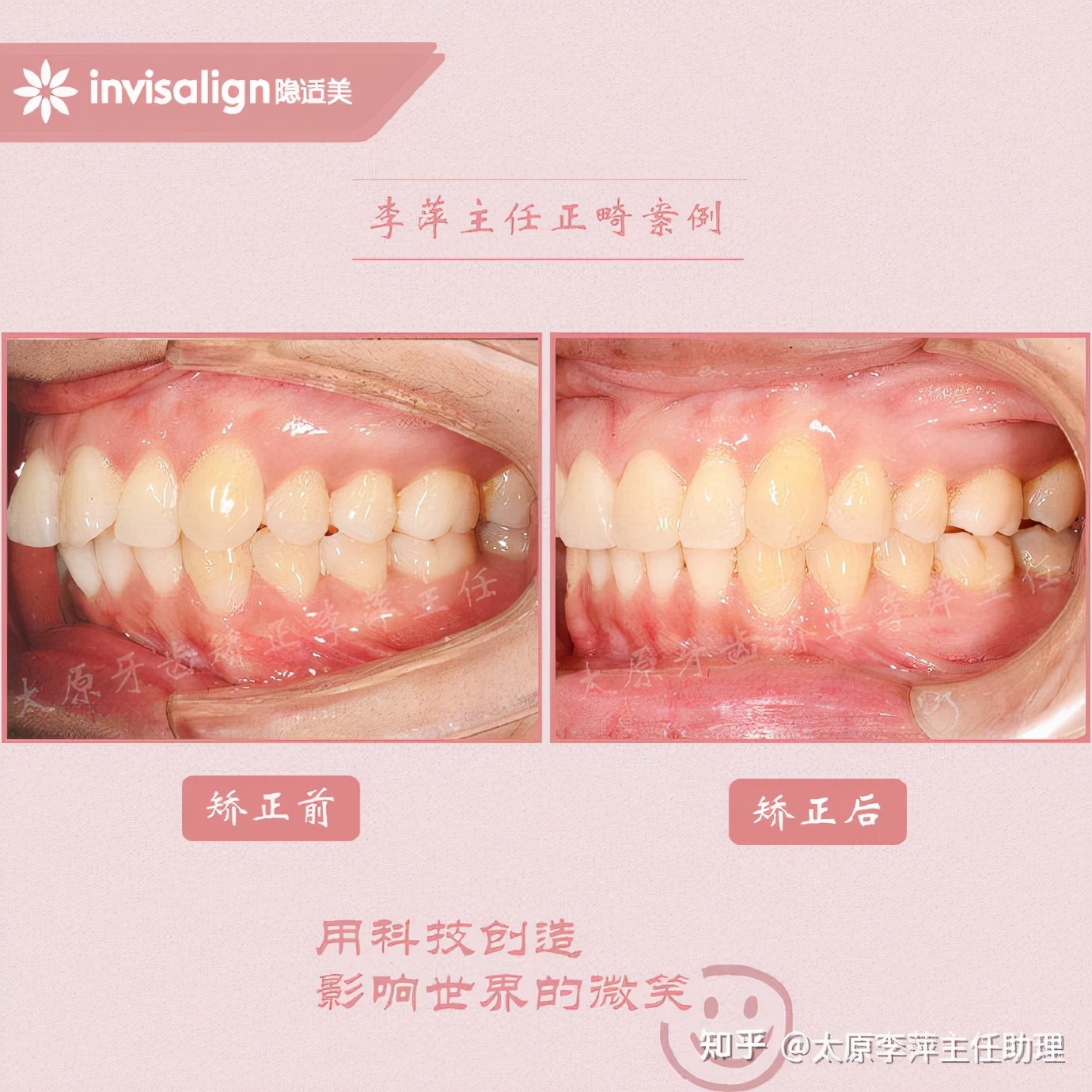太原牙齿矫正靠谱吗,太原成人隐形牙套牙齿不齐