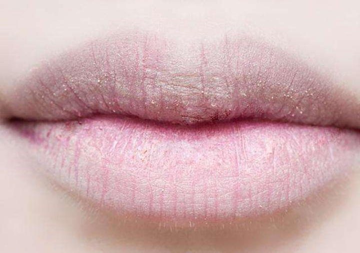 嘴唇干燥紧绷喝水无法缓解,解决嘴唇干燥的小妙招