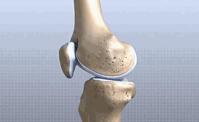 打封闭止痛快？去骨刺不再痛？骨关节炎患者止痛需避开四大陷阱