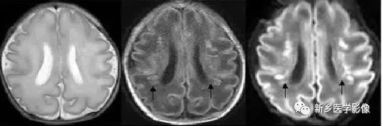 什么引起成人脑室扩大,哪些病可以导致左侧脑室增宽