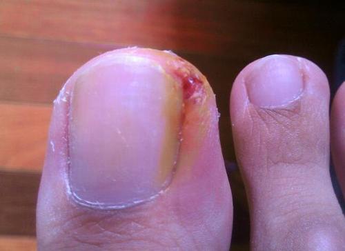 啃指甲甲沟炎,拔肉刺引起甲沟炎