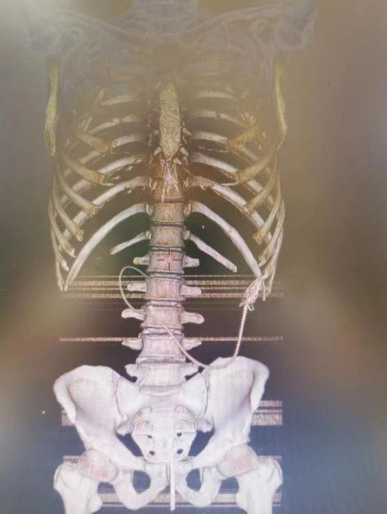 活久见！兴化男子为治便秘将黄鳝塞进直肠，黄鳝咬穿肠子进入腹腔