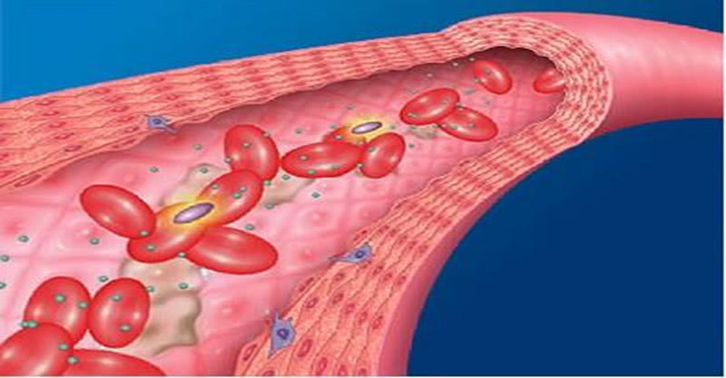颈动脉有斑块可以吃降血脂中成药,有颈动脉斑块的适合吃什么降压药