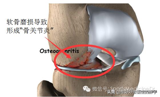 半月板损伤通常是单膝还是双膝,你知道半月板是什么吗