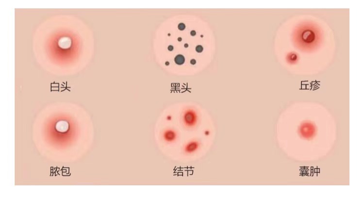 男士祛痘用什么护肤品比较好,男士祛痘护肤品官方旗舰店直播