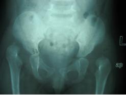 儿童发育性髋脱位表现,发育性髋关节脱位治疗4-7岁