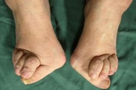 类风湿怎样才算控制住了不再复发,类风湿真的就治不好了吗