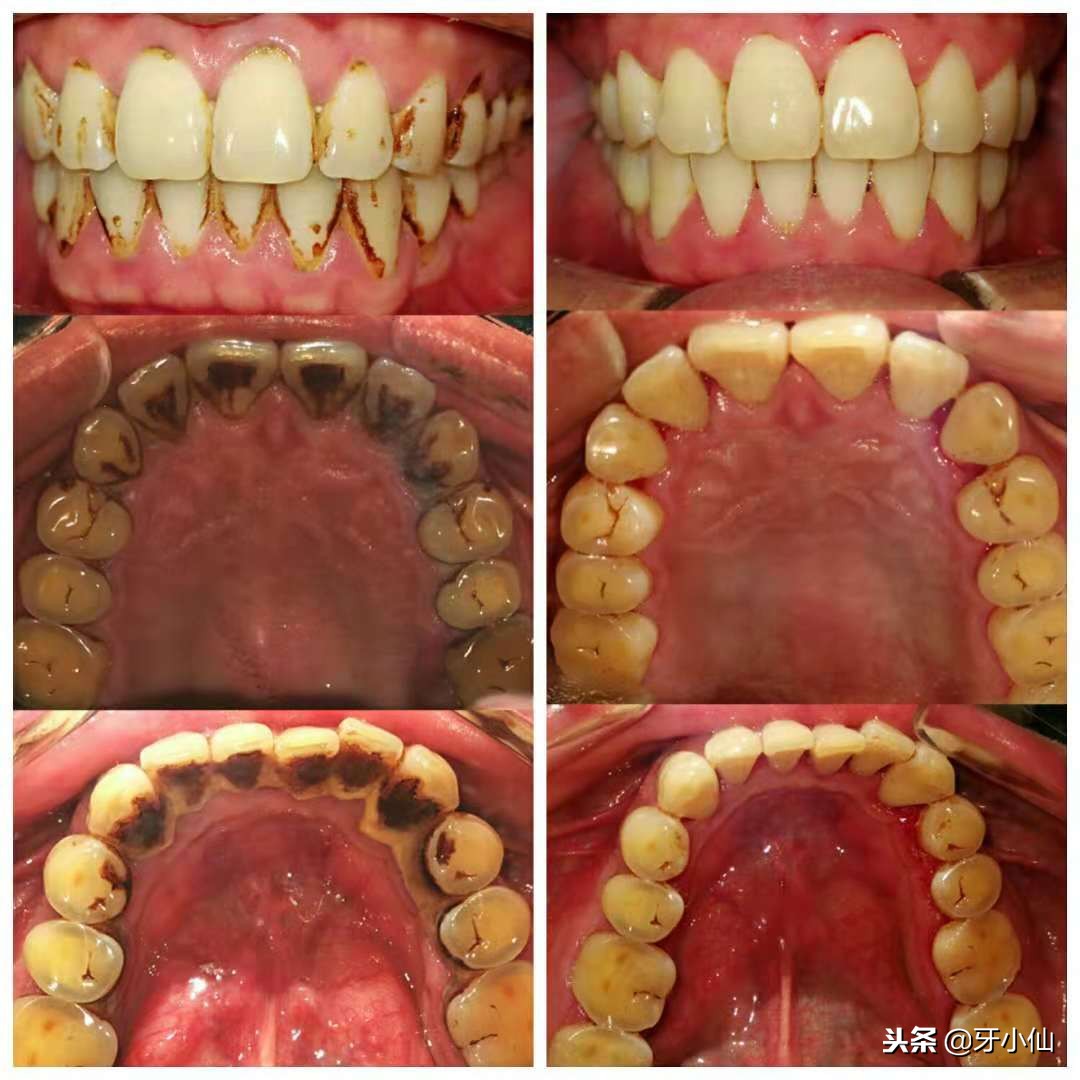 洗牙后不上药有关系吗,洗牙后不封釉有关系吗