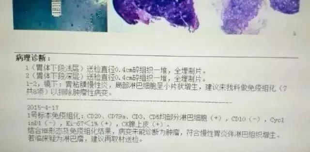 如何看懂胃镜活检报告,胃镜病理活检报告一般需几天