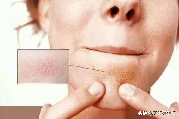 下巴有白色颗粒怎么解决,下巴有白色颗粒凸起是什么原因