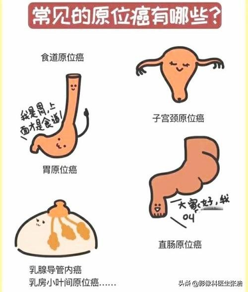 原位癌没有复发会发生转移吗,原位癌未转移可以根治吗