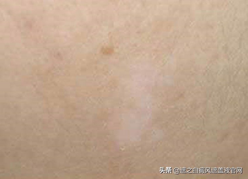 治疗白癜风时务必重视这几大事项,外用药治疗白癜风