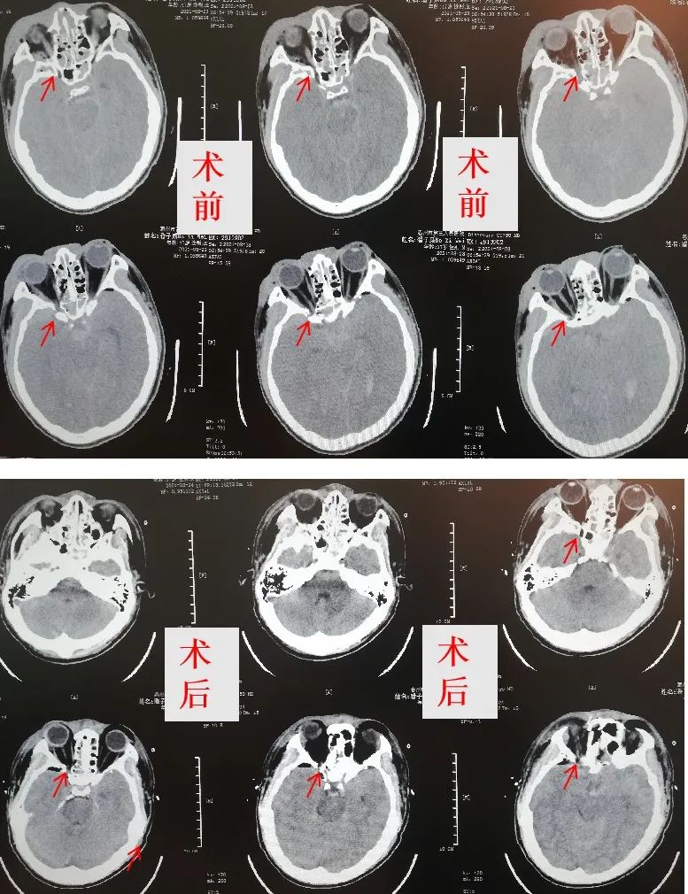 车祸视神经压迫失明的恢复几率,车祸视神经损伤中医针灸成功案例
