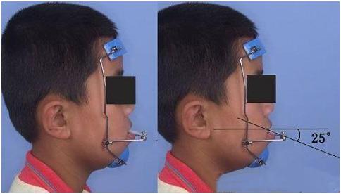 孩子嘴巴地包天有什么说法吗,小孩嘴地包天
