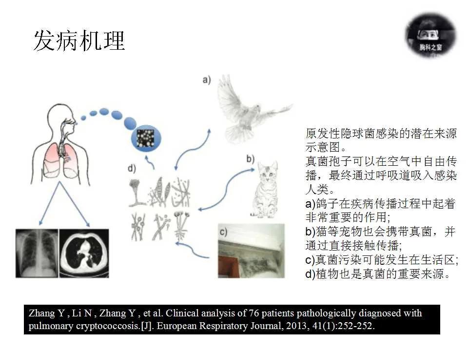 双肺多发结节是肺癌的征兆吗,双肺多发结节灶