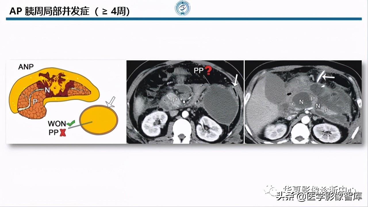核磁ct都显示急性胰腺炎,急性坏死性胰腺炎的ct表现