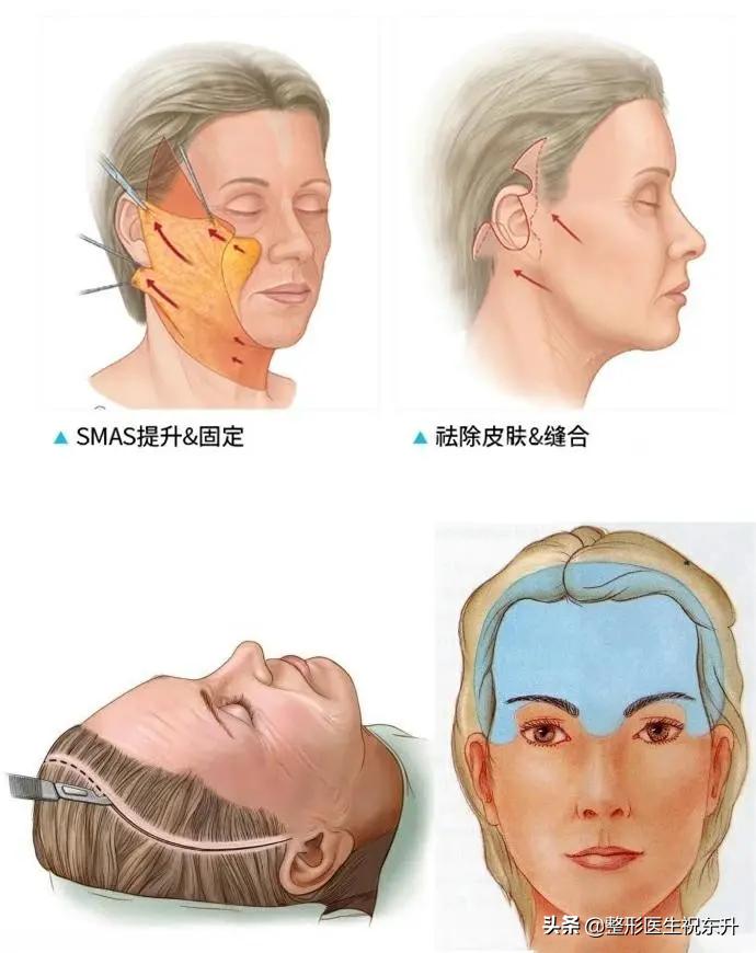 拉皮有后遗症吗会不会越老越快,50岁拉皮手术有生命危险吗