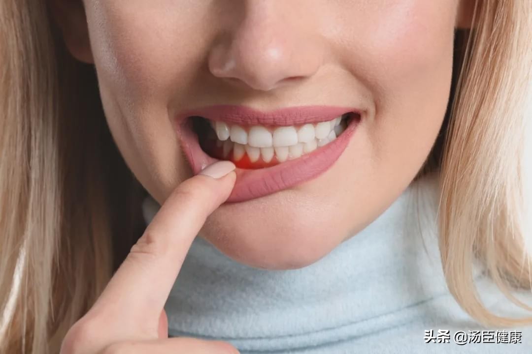 牙周炎很多人都有吗,牙周炎人人都有吗