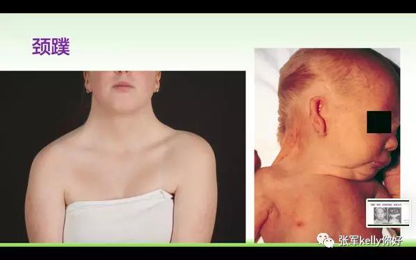 Turner综合征的指南学习