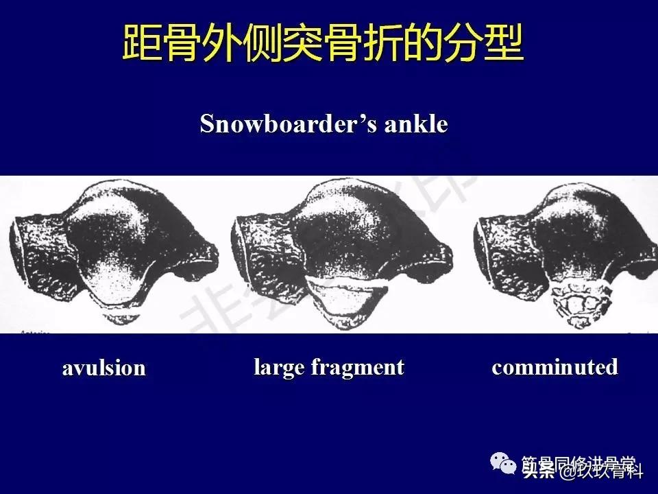 距骨骨折的治疗原则,距骨骨折如何调理