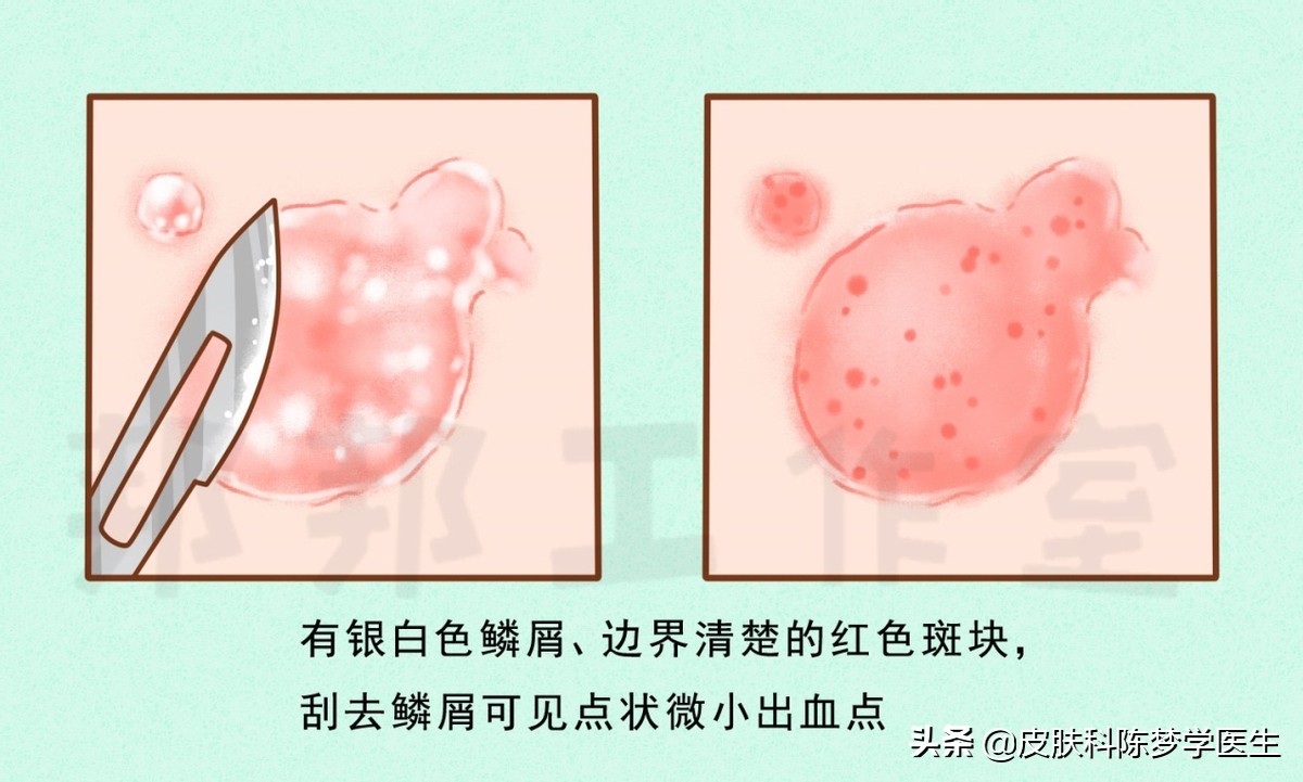 皮肤上的红斑可能是牛皮癣吗,红斑和脱屑的牛皮癣