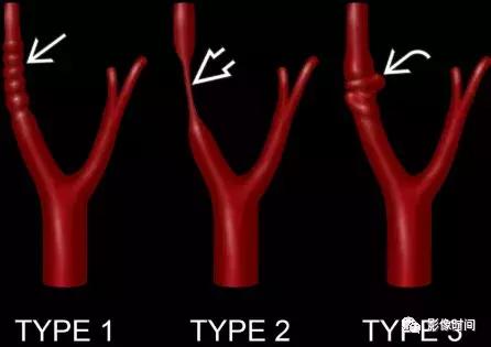 双侧颈动脉鞘间隙多发小淋巴结影,双侧颈动脉间隙多软组织密度结节