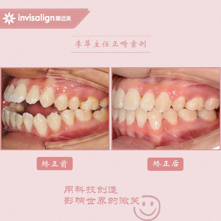 太原矫正牙齿需要做正颌吗,太原牙齿二次矫正