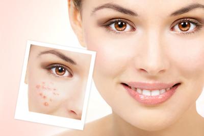 脸上起小痘痘怎么办医美,医美脸上长痘坑坑洼洼的怎么修复