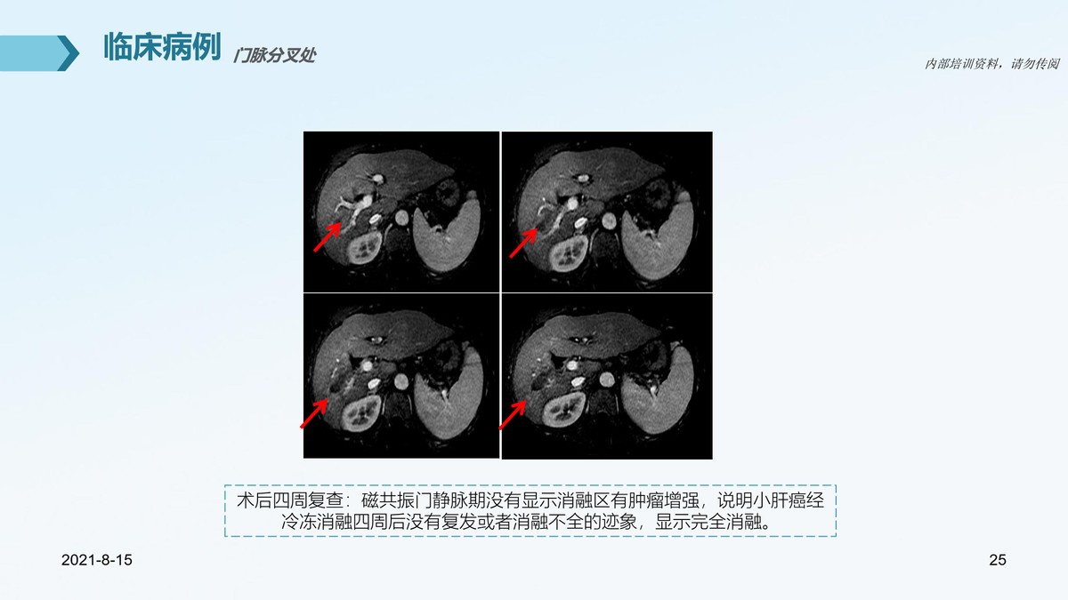氩氦刀治疗肿瘤的医院,氩氦刀治疗肿瘤范围多大