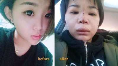 “她的整容脸，靠15次手术固定”：不要命的美，害了多少年轻女孩