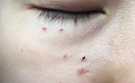 手动去脂肪粒工具,去脂肪粒神器排行榜