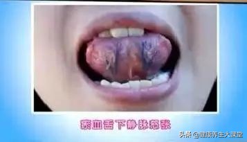 这么多病都是瘀血造成的，化解妙招送给你（深度好文）