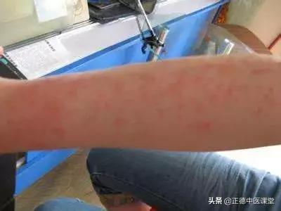 日光性皮炎该怎么办,中医治疗日光性皮炎