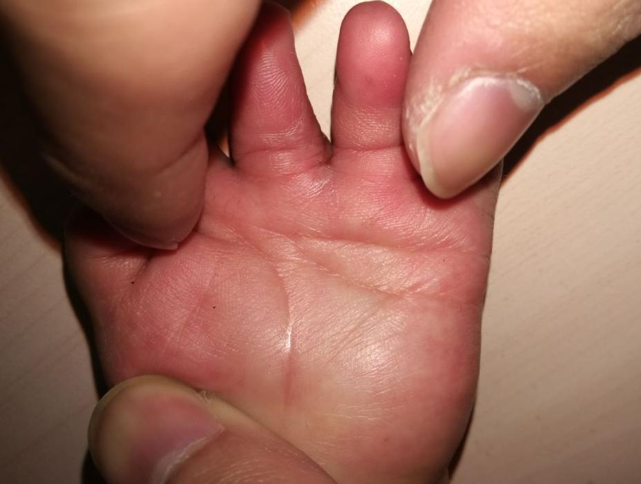 并指畸形免植皮案例,并指畸形