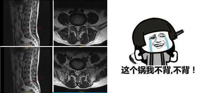 坐骨神经痛是糖尿病引起的吗,被糖尿病并发症吓到