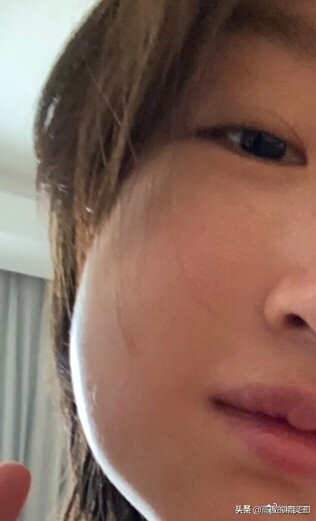 周冬雨拔智齿，五天后脸仍然肿成包子，评论区一片笑声