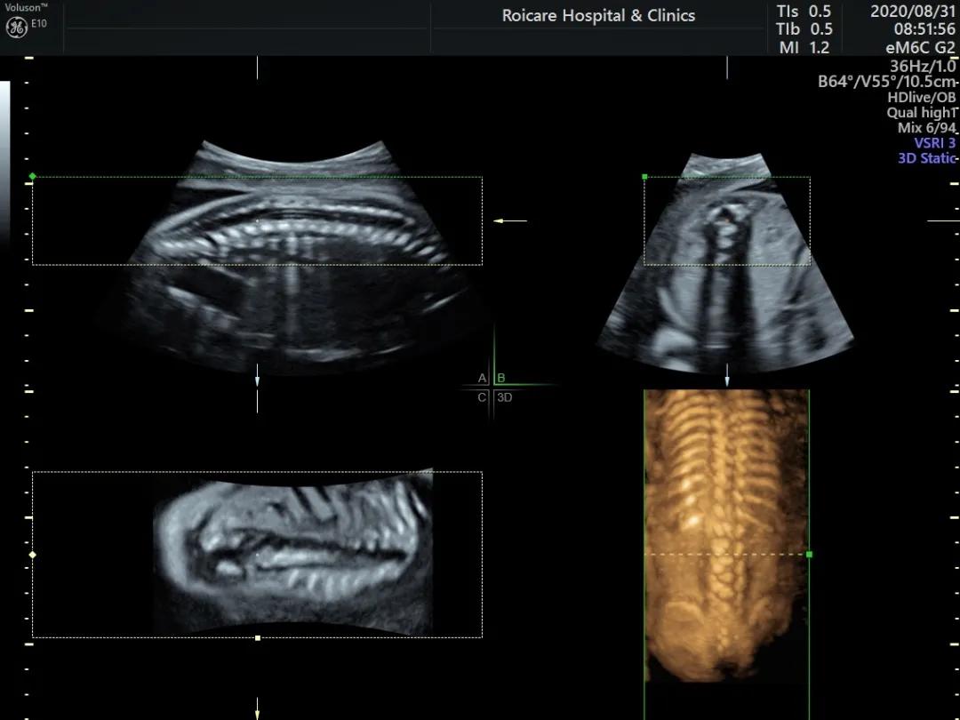 胎儿期发现脊髓圆锥位置低的临床指导