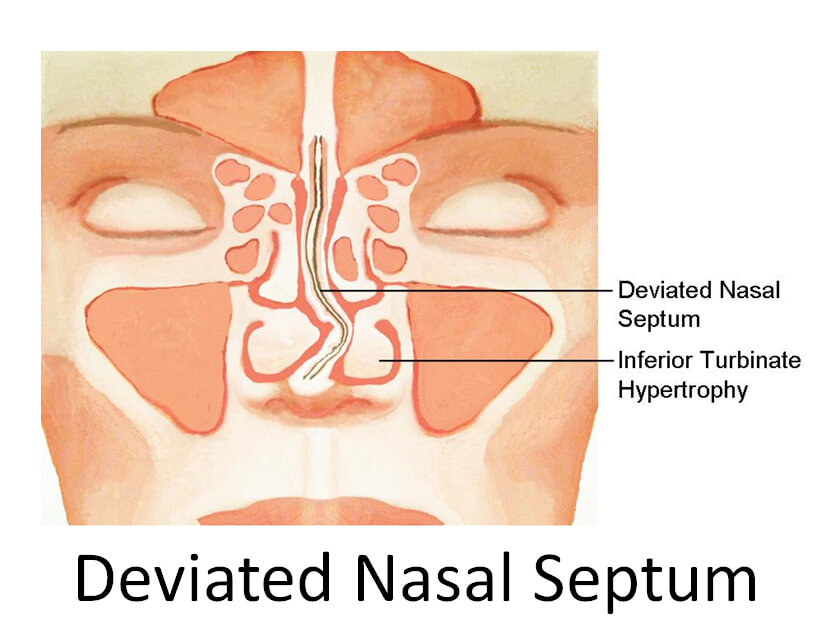 鼻窦炎停了抗生素鼻甲又肿起来了,鼻窦炎为什么很难治愈
