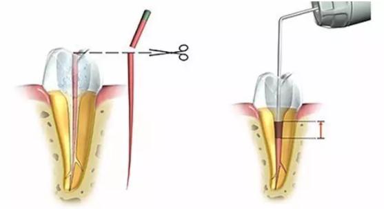 杀神经根管治疗的费用,杀神经根管治疗后可以直接补牙吗